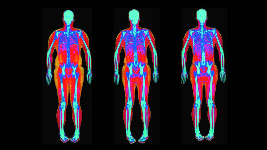 Sample of a DEXA scan
